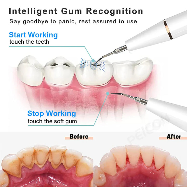 "Sleek women's ultrasonic tooth cleaner for plaque removal, featuring advanced design and technology for oral hygiene."